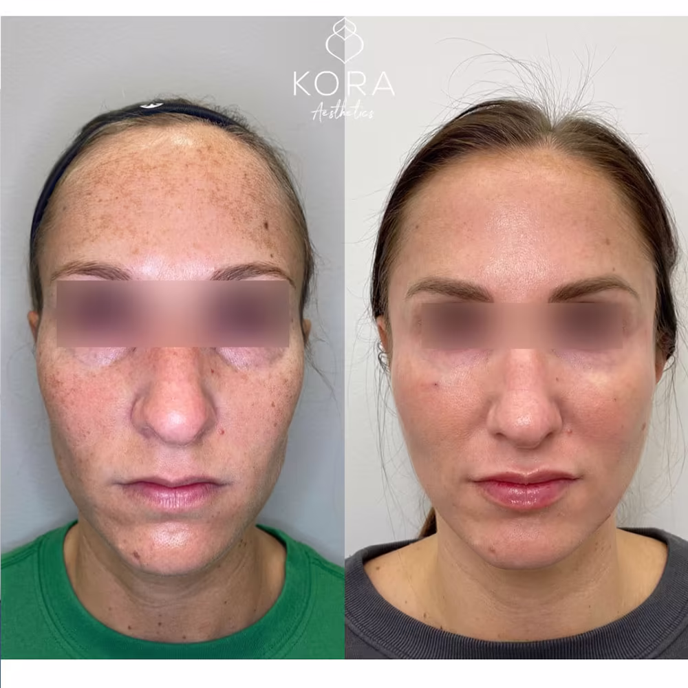 Sculptra Face treatment