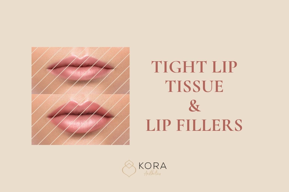 Tight Lip Tissue and Lip Fillers: What You Should Know for the Best Results