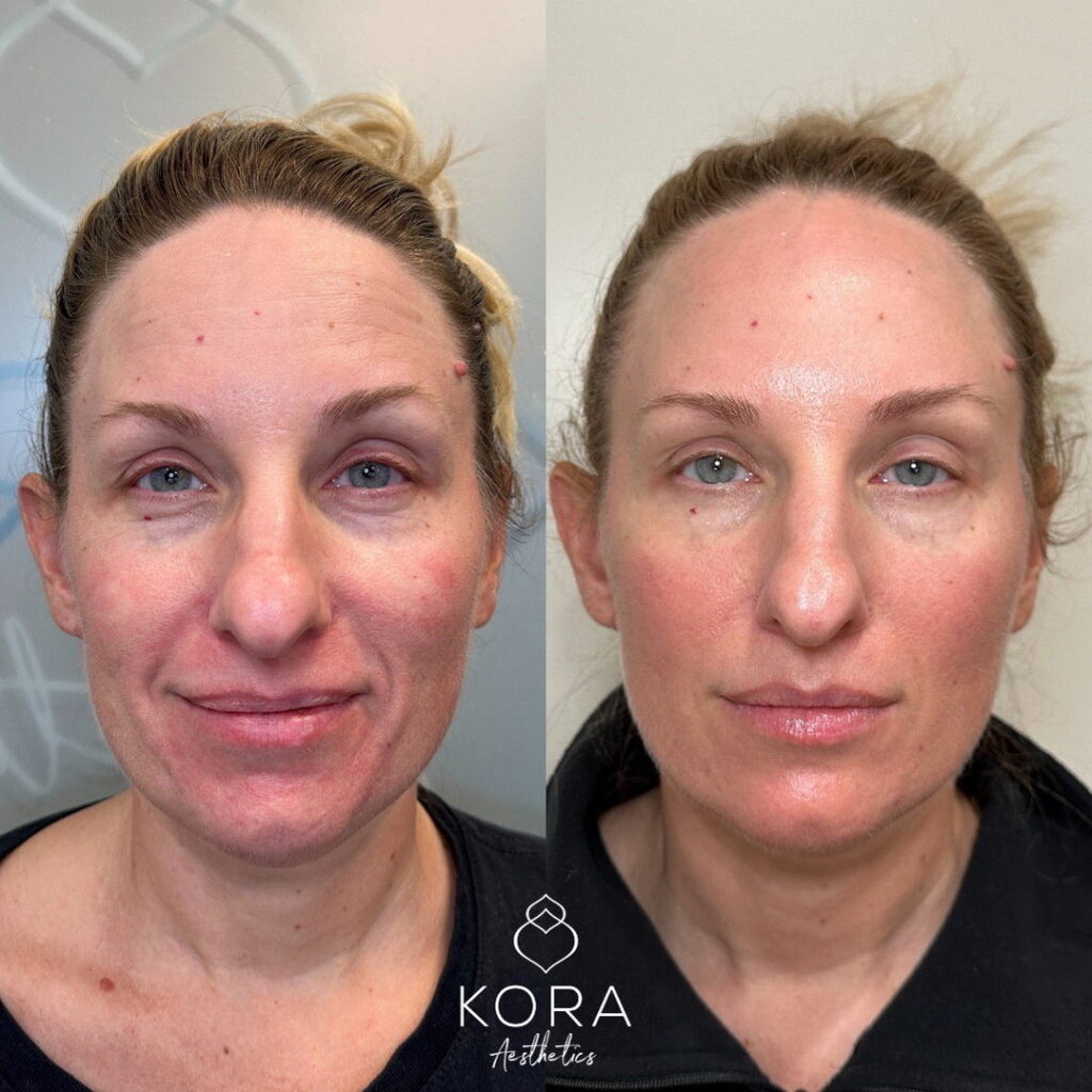 Before and after results of PRF EZ Gel natural volume restoration and under-eye rejuvenation treatment in Scottsdale