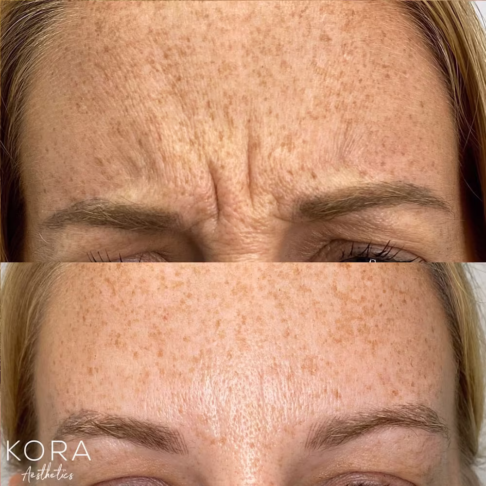 Close up before and after view showing complete smoothing of deep glabellar 11 lines between the eyebrows following Botox in Scottsdale