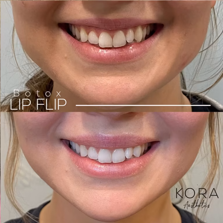 Botox Lip Flip patient #00016 before and after