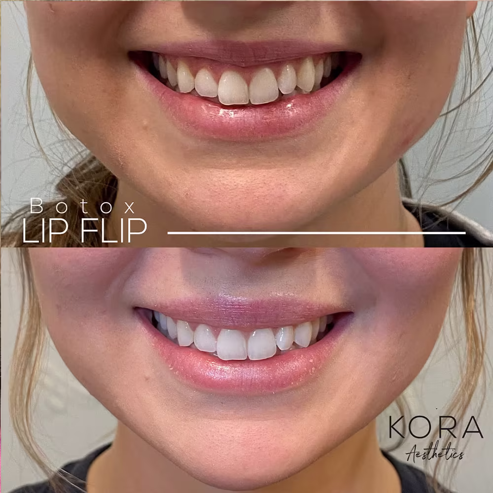 Before and after results of a Botox lip flip treatment to reduce gum display and enhance lip shape in Scottsdale