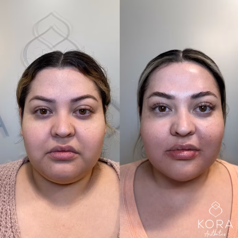 Juvéderm Smile Lines patient #0005 before and after