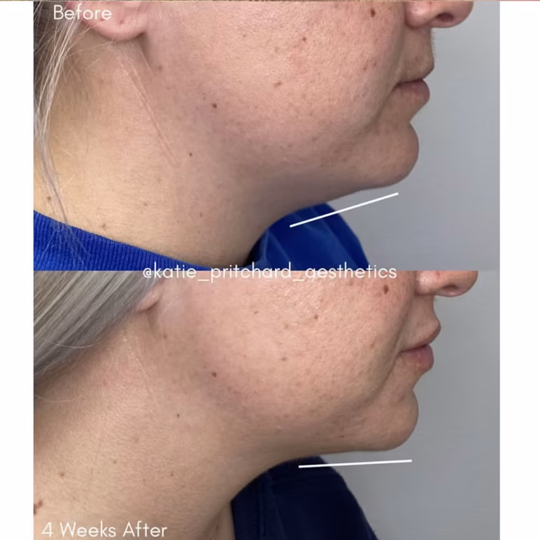 Kybella Double Chin patient #0008 before and after