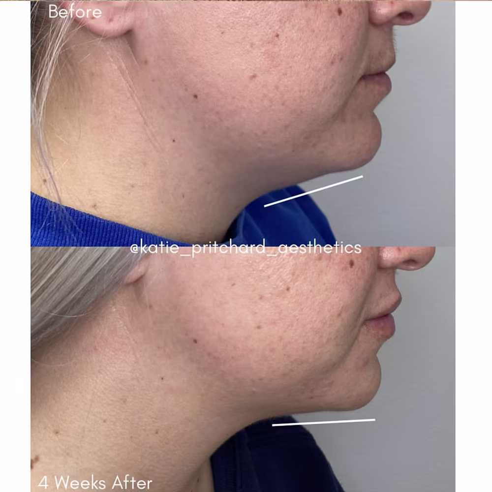 Before and after results of Kybella fat-dissolving injections for double chin reduction in Scottsdale