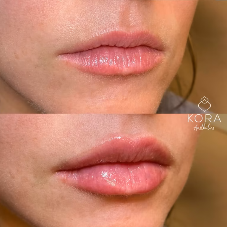 Lip Filler patient #0004 before and after
