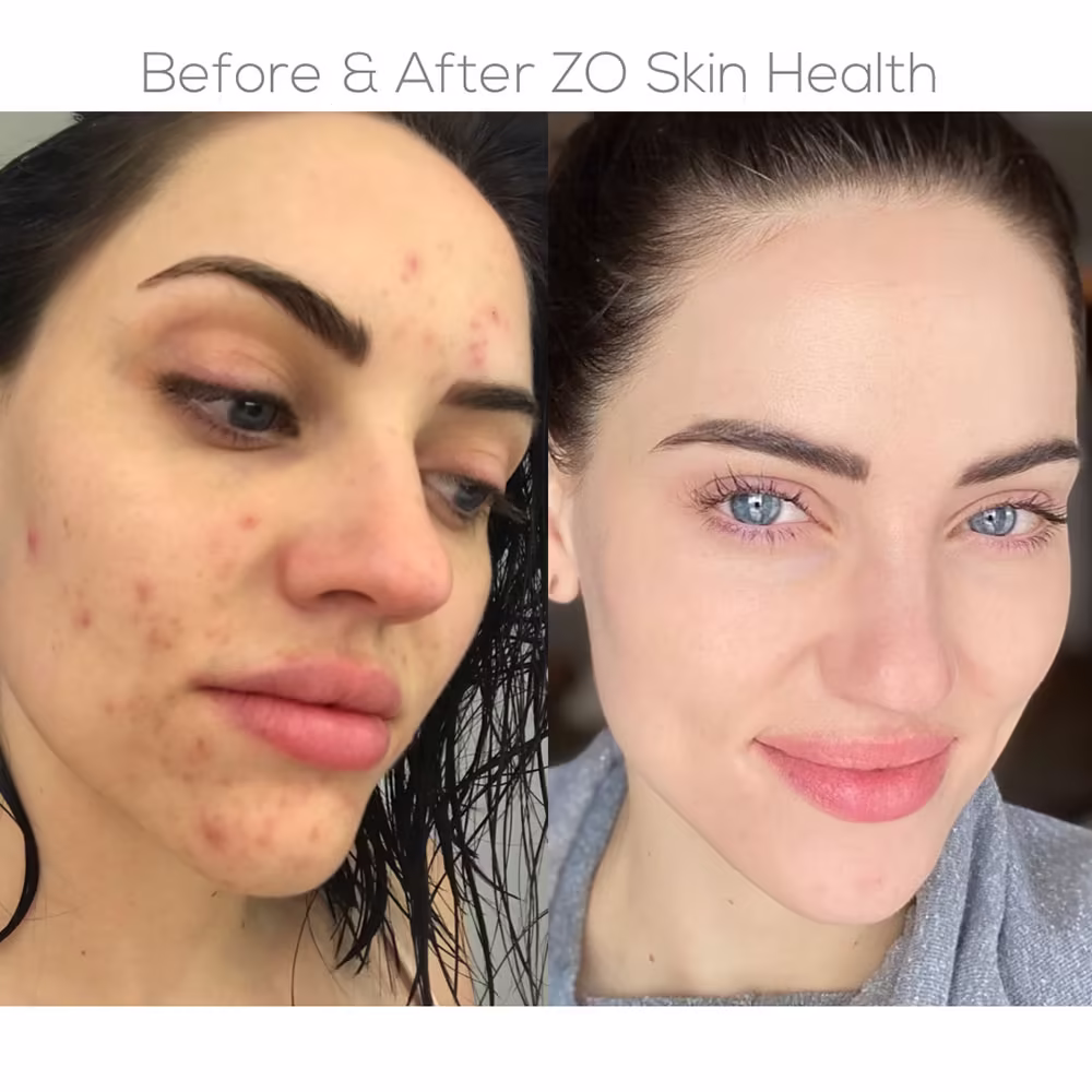 Before and after results of ZO Skin Health medical-grade skincare treatment for acne and hyperpigmentation in Scottsdale