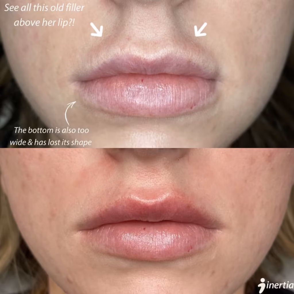 Before and after results of hyaluronidase lip filler dissolving treatment to correct migration in Scottsdale