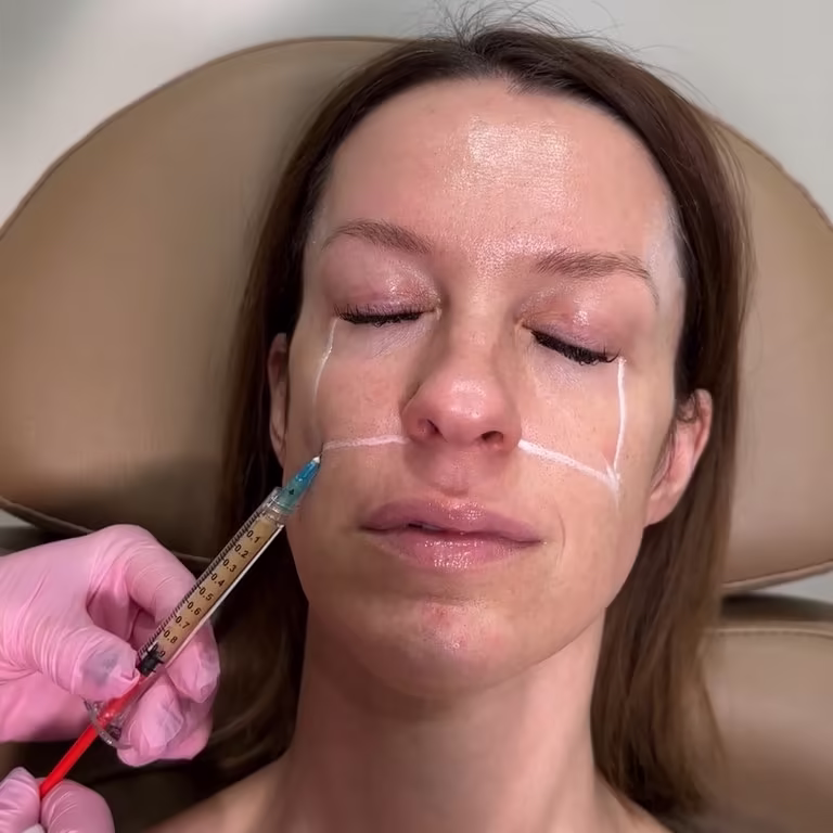 Professional autologous PRF injection treatment for skin rejuvenation in Scottsdale