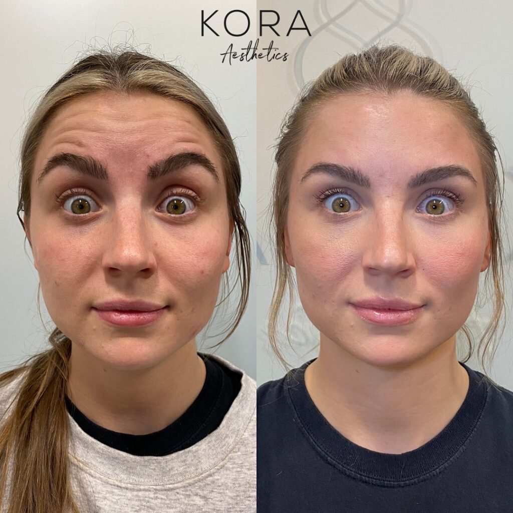 Before and after comparison of forehead injectable treatment showing significant smoothing of dynamic forehead creases and lines in Scottsdale