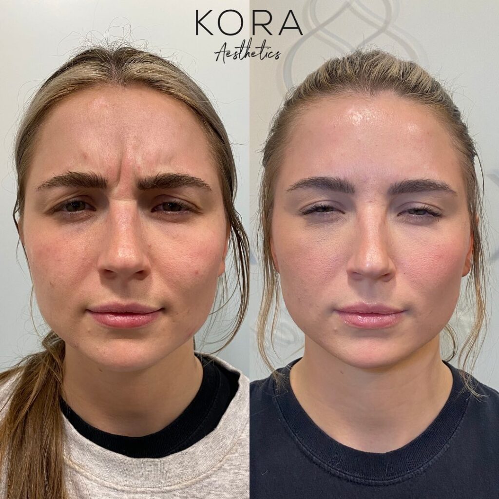Botox Frown Lines before and after