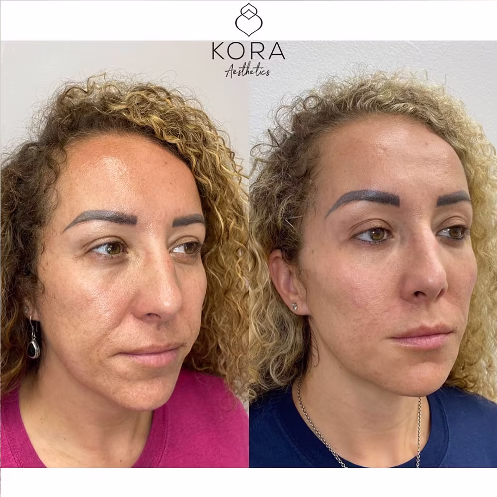 Before and after results of Juvéderm dermal filler treatment for smile lines and nasolabial folds in Scottsdale