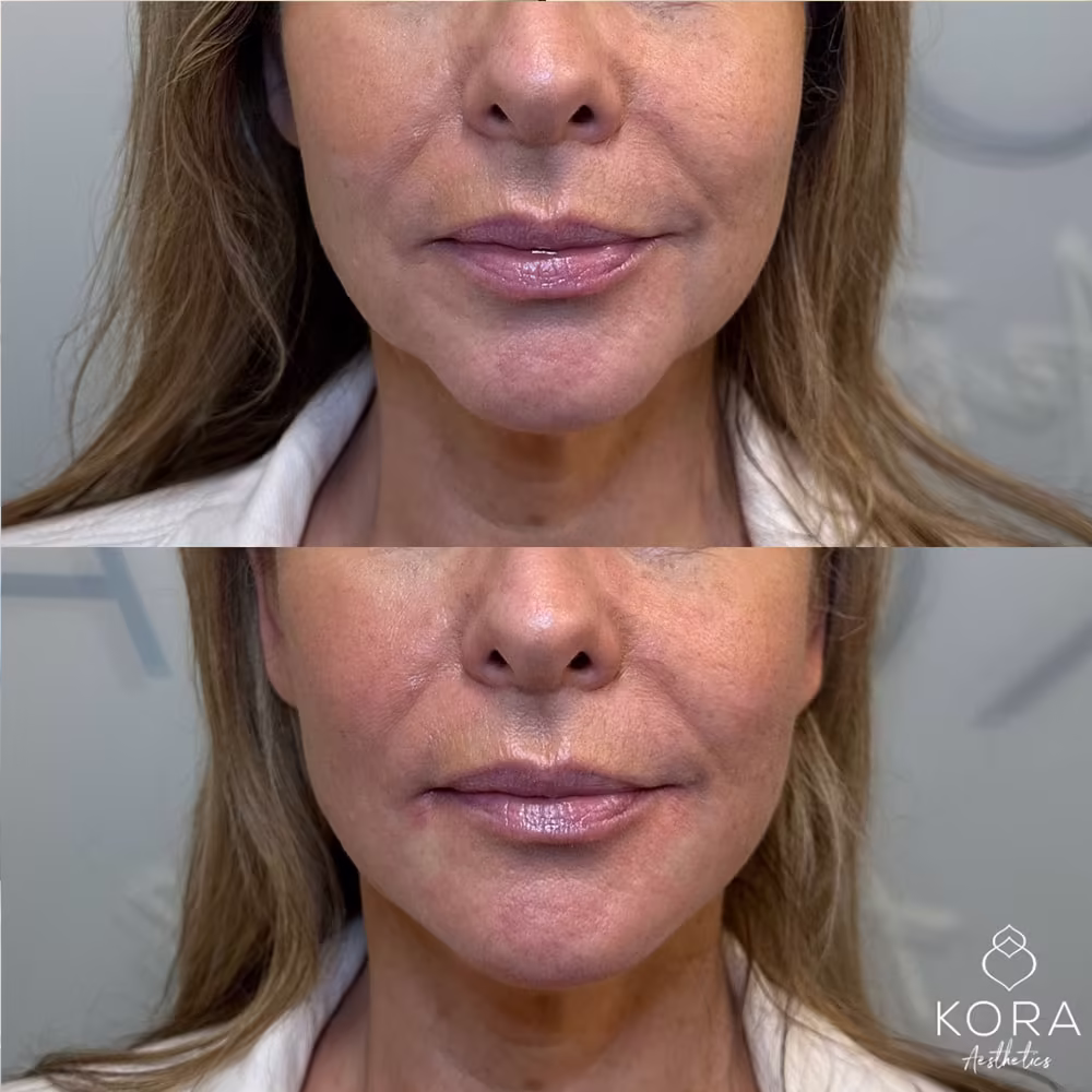 Before and after results of a 2 ml dermal filler treatment for sharper jawline definition in Scottsdale