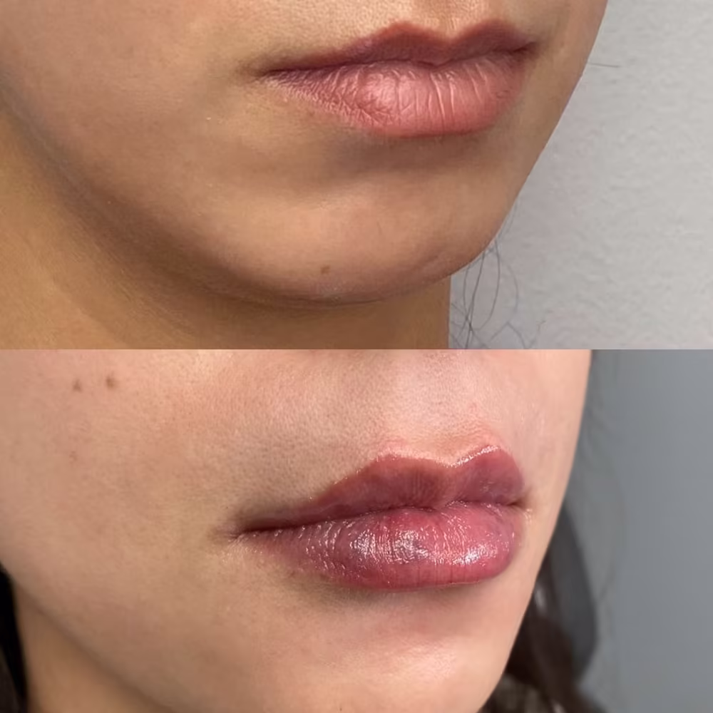 Angled before and after view of lip filler treatment improving lip projection and plumpness in Scottsdale