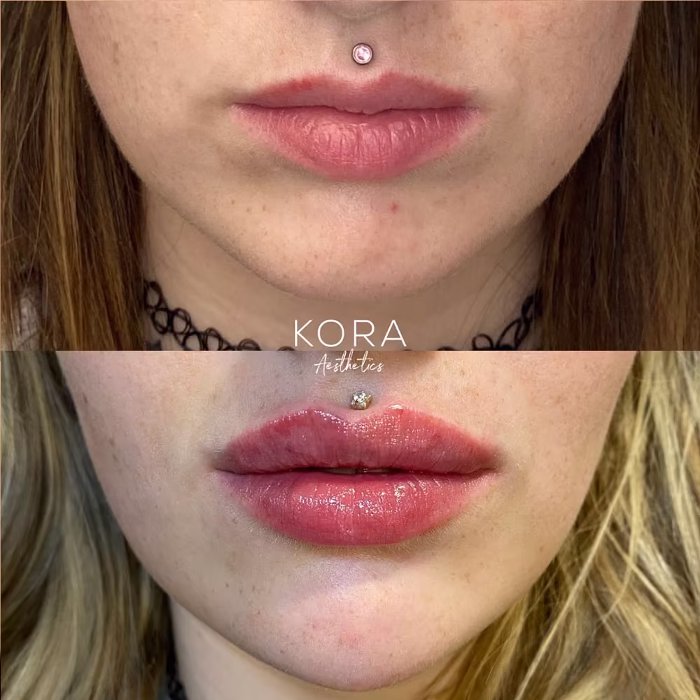 Before and after results of a 1 ml micro-droplet lip filler treatment for natural volume in Scottsdale