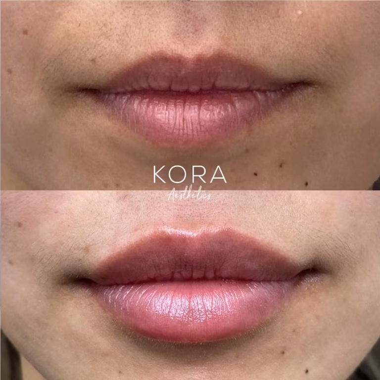Dermal Filler Lips Fillers patient #00025 before and after
