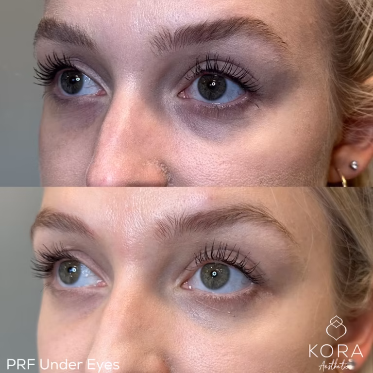PRF Injections Under Eyes patient #00011 before and after