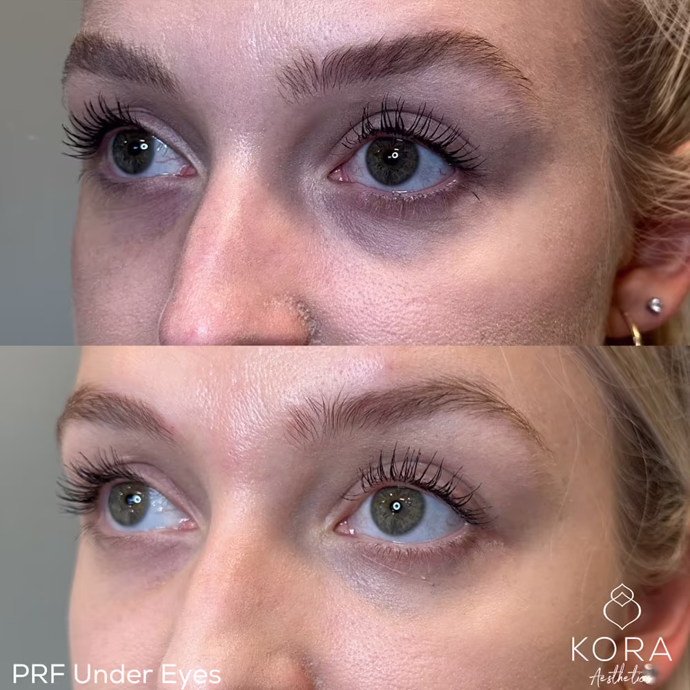 Before and after results of PRF injections for under-eye dark circles and hollowness in Scottsdale