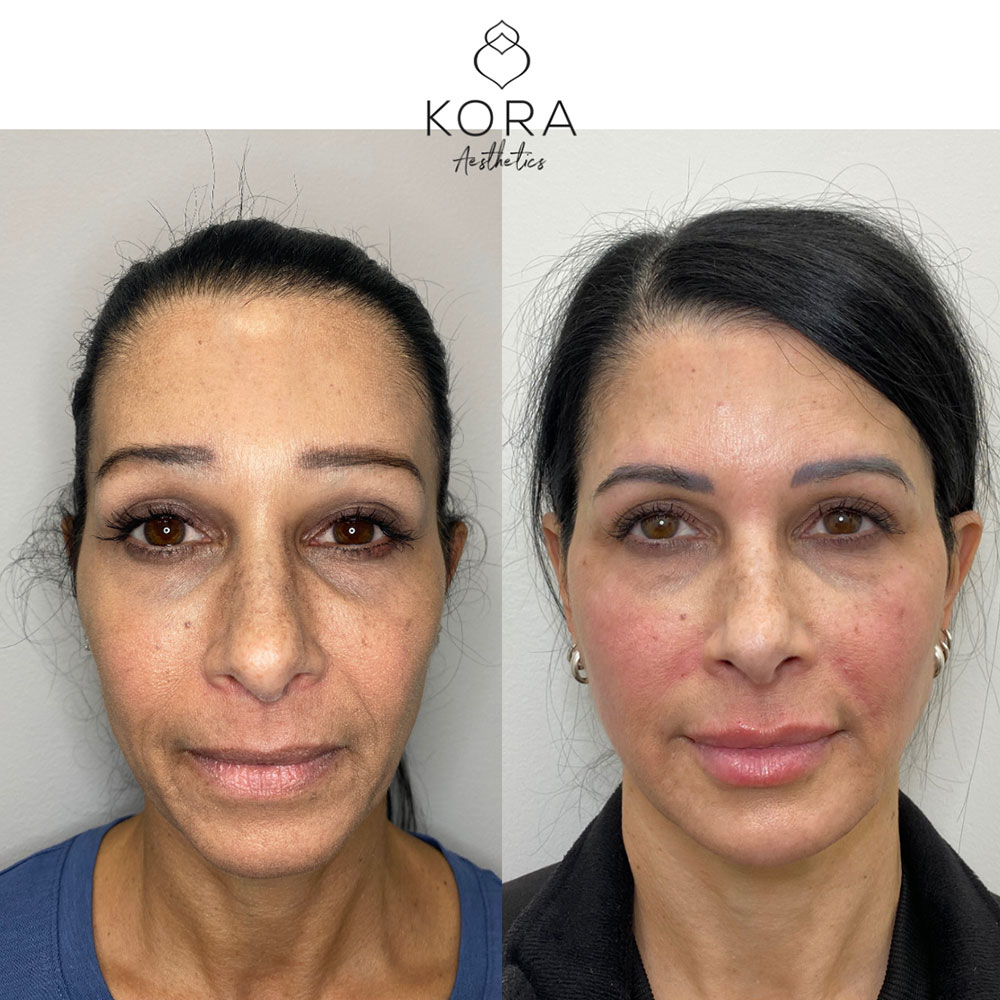 Before and after results of Sculptra collagen-stimulating biostimulatory treatment for face and neck in Scottsdale