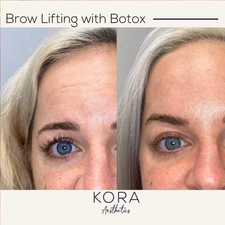 Botox Brow Lift patient #00018 before and after