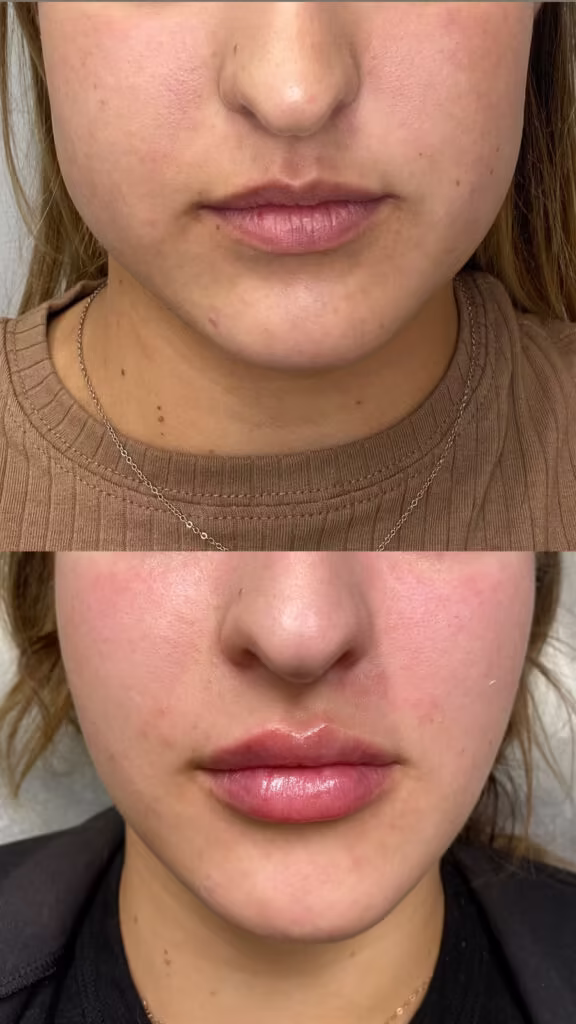 Botox Jawline Slimming patient #00020 before and after