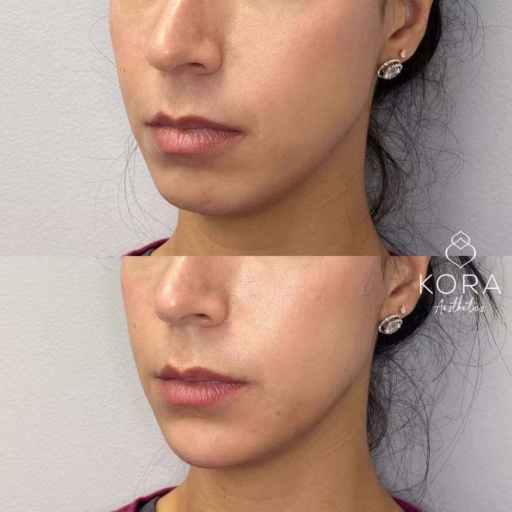 Three-quarter angle view before and after showing chin filler lengthening the lower face in Scottsdale