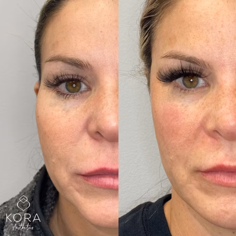 Dermal Filler Temples patient #00027 before and after