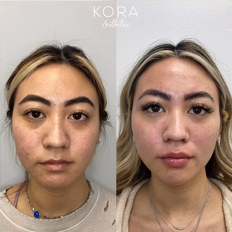 Dermal Filler Under Eye Fillers patient #00028 before and after