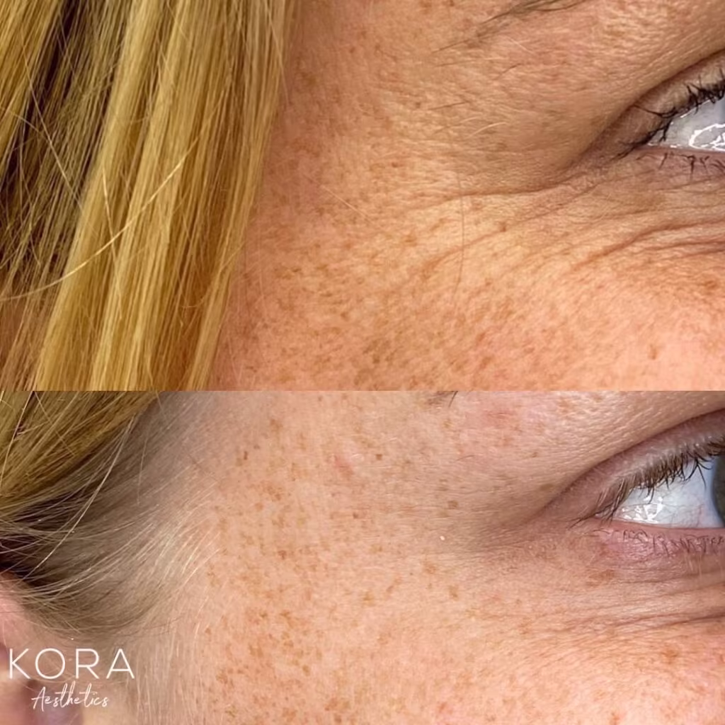 Close up before and after side-by-side comparison showing treatment of crow's feet fine lines around the eye in Scottsdale