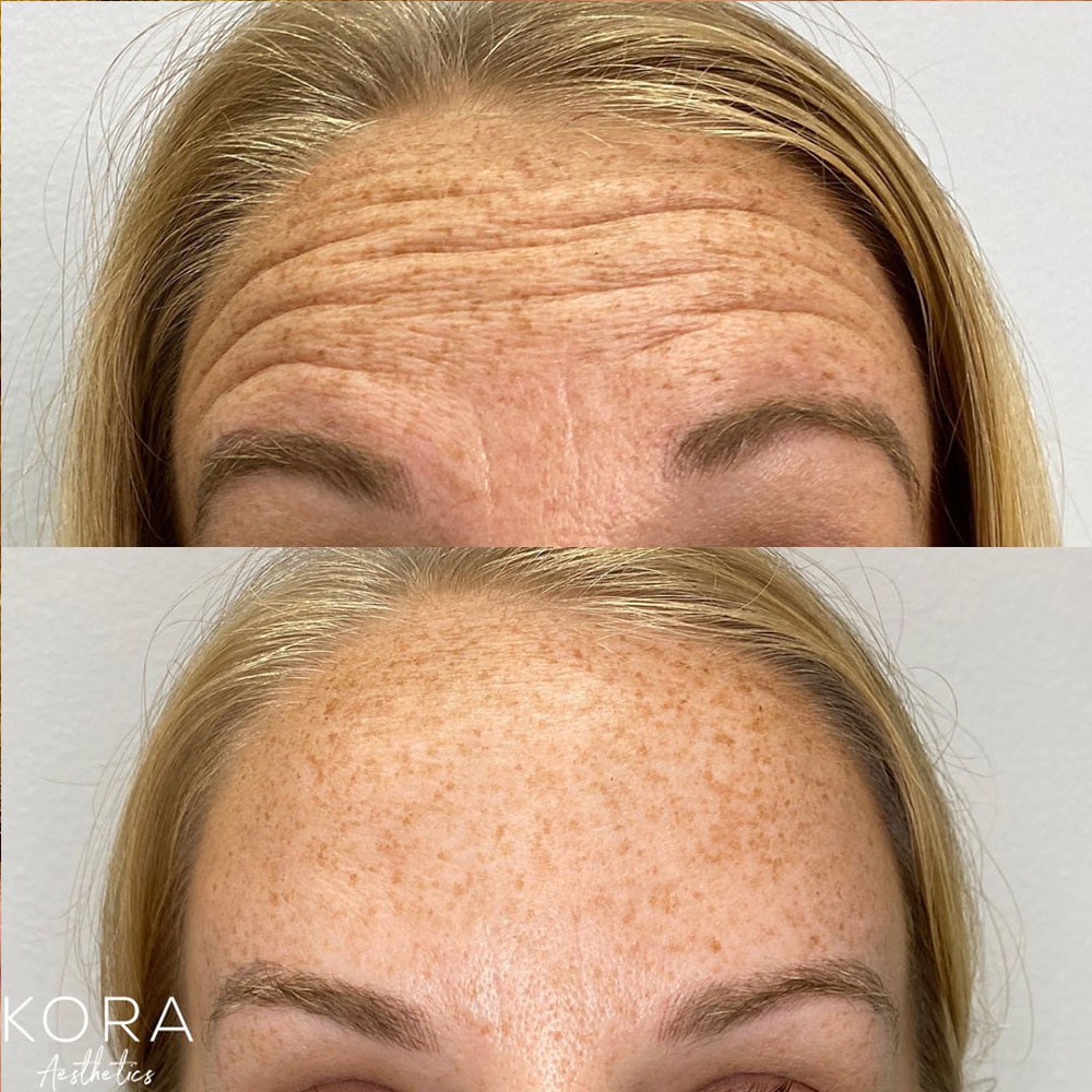 Before and after view of horizontal forehead lines and expression wrinkles treated with neuromodulators in Scottsdale