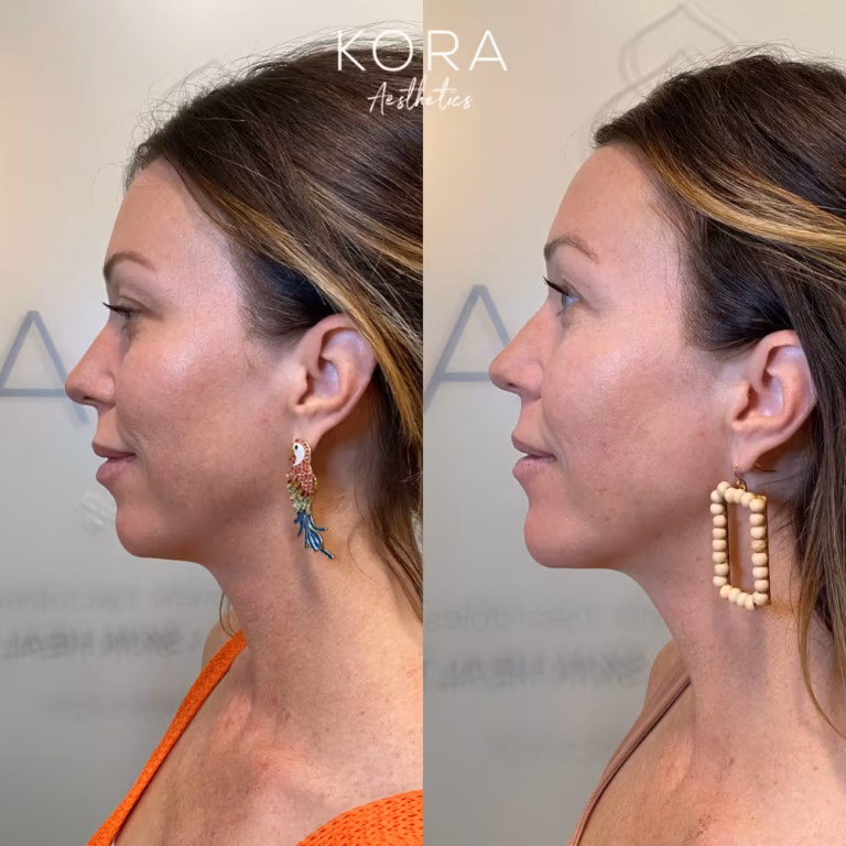 Juvederm Chin Fillers patient #00029 before and after