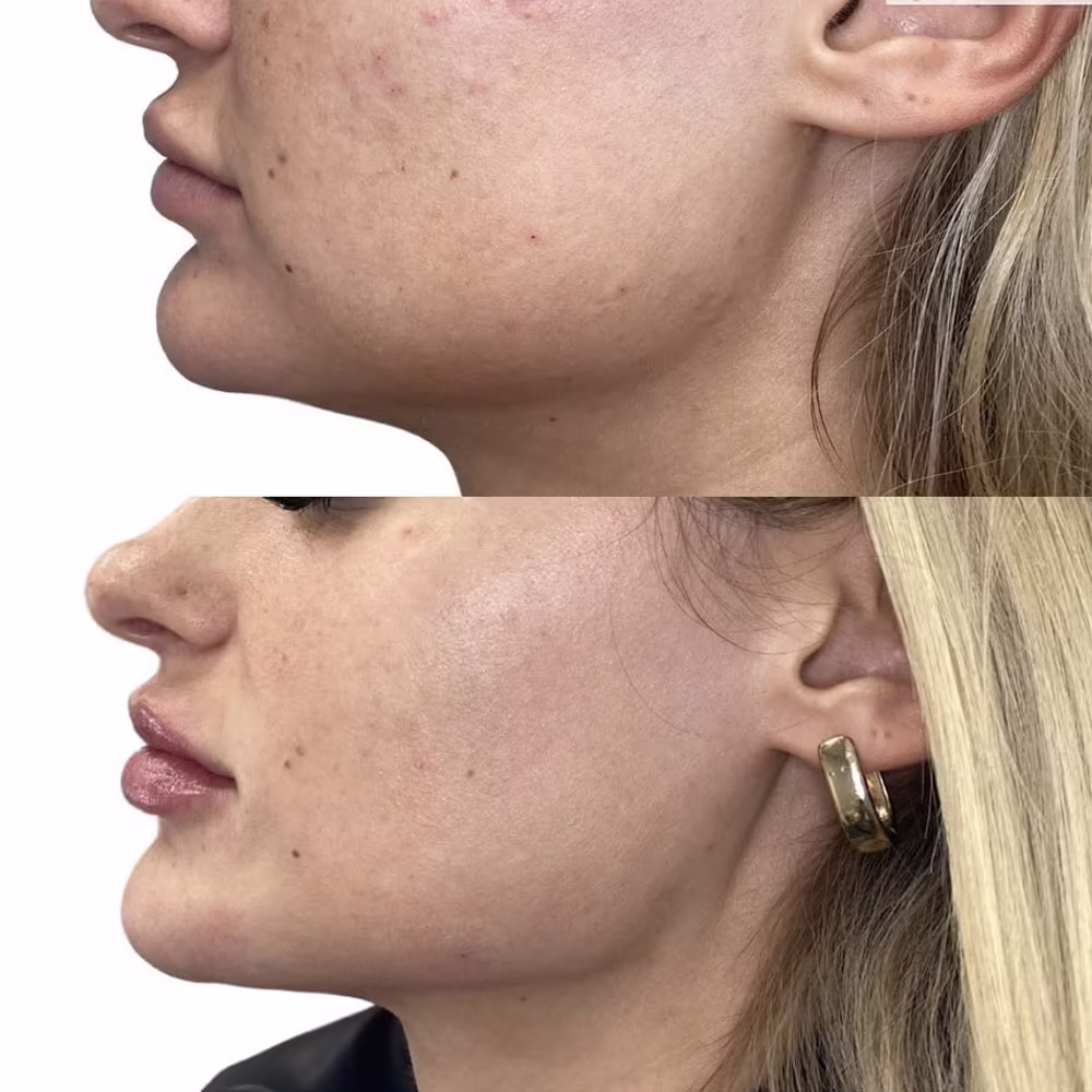 Profile before and after photo of jawline dermal filler creating a sharp jaw angle in Scottsdale