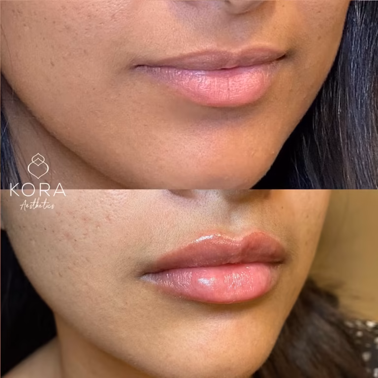 Juvederm Lips Fillers patient #00033 before and after
