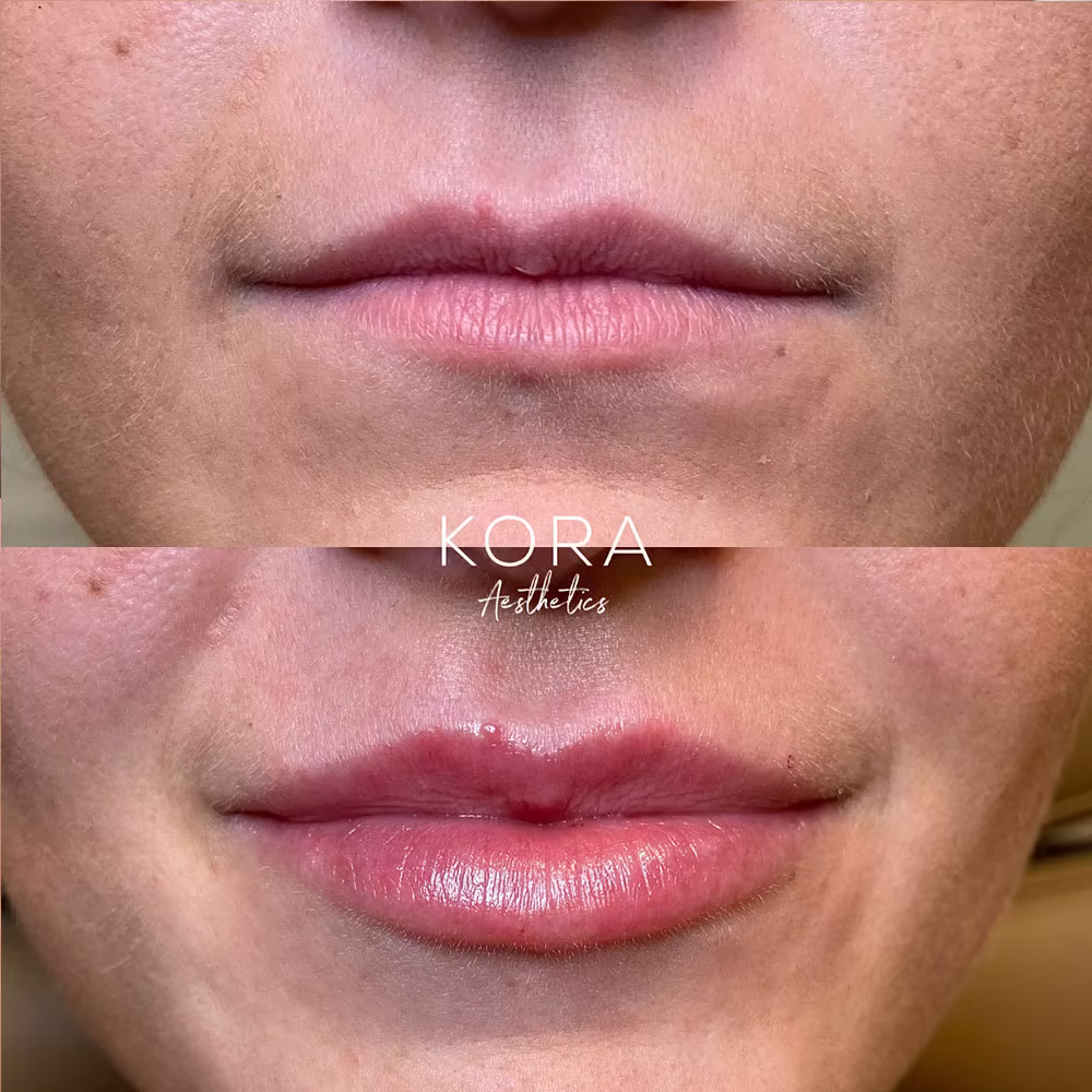 Frontal close-up before and after view showing lip filler adding symmetrical volume and smoothing lip lines in Scottsdale
