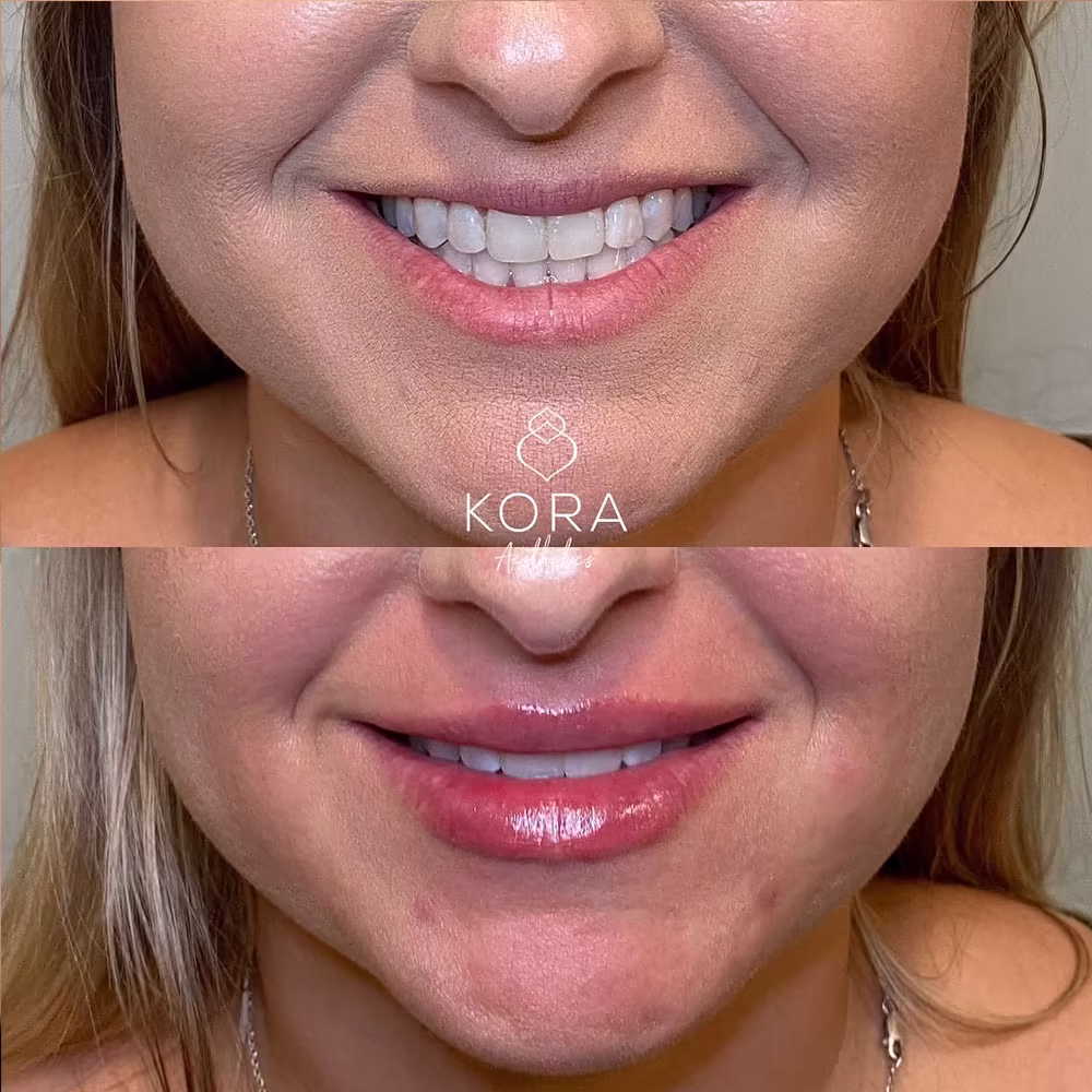 Smiling before and after view showcasing lip filler preventing upper lip thinness during a smile in Scottsdale