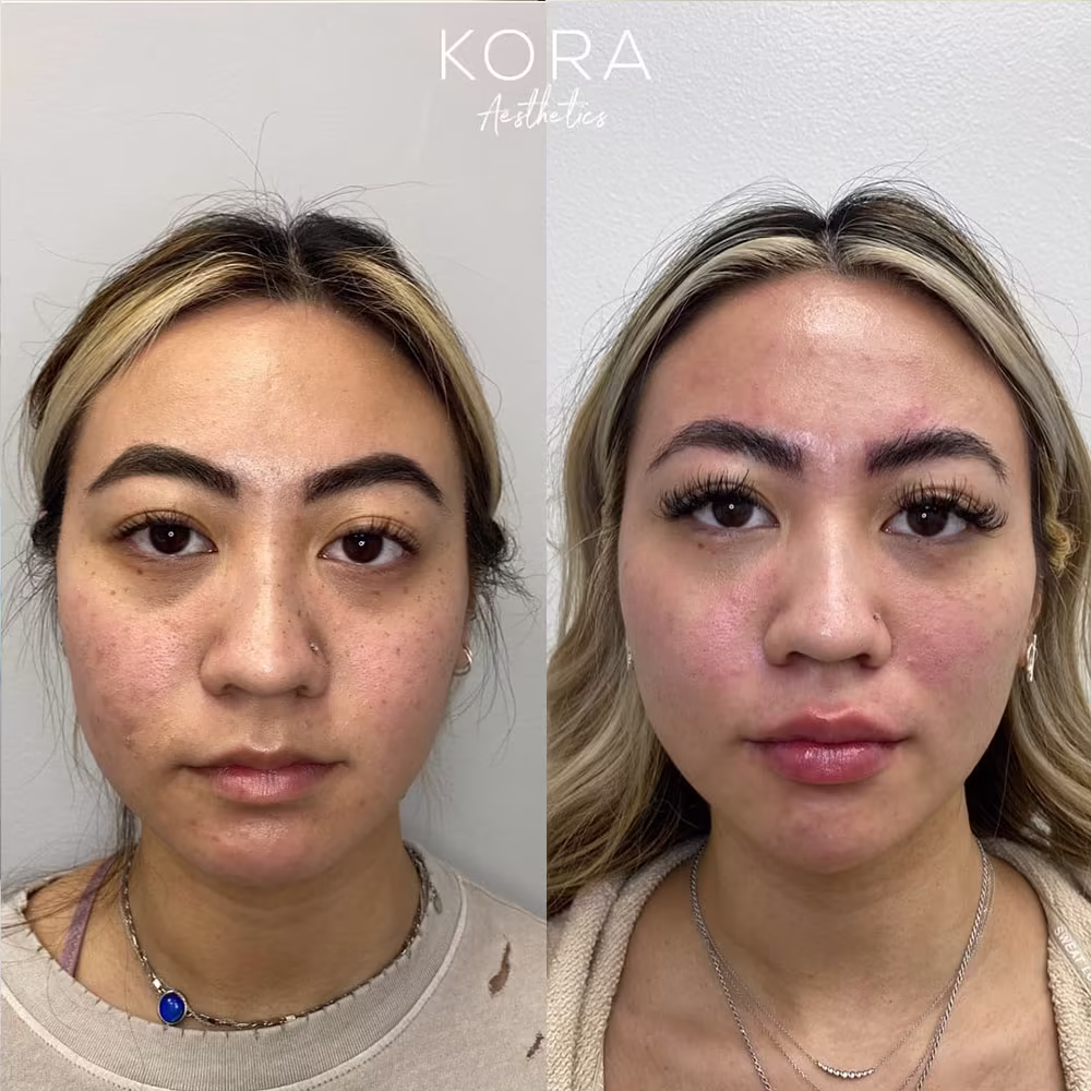 Frontal view before and after under eye dermal filler treatment restoring volume to the tear troughs in Scottsdale