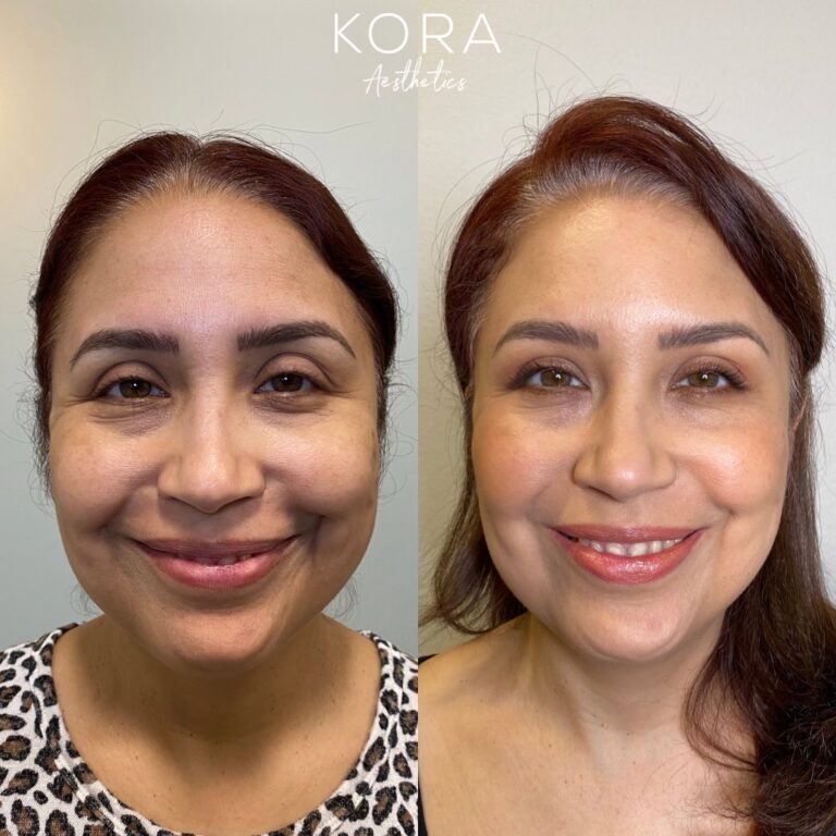 Botox for Crow’s Feet patient #00015 before and after